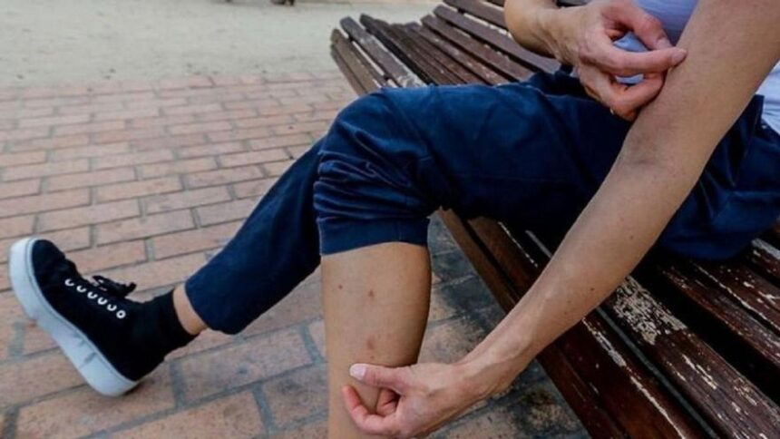sarna:-los-dermatologos-alertan-de-la-ola-de-contagios-y-el-«fracaso»-de-los-tratamientos-para-la-enfermedad