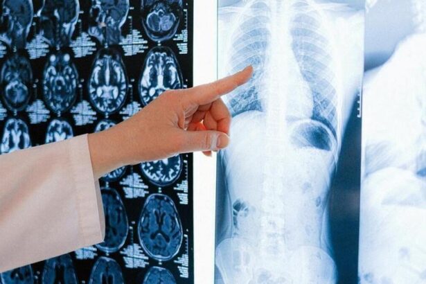 un-farmaco-reduce-la-recaida-de-un-76%-de-los-pacientes-con-un-tipo-de-cancer-de-pulmon-que-afecta-a-jovenes-y-no-fumadores