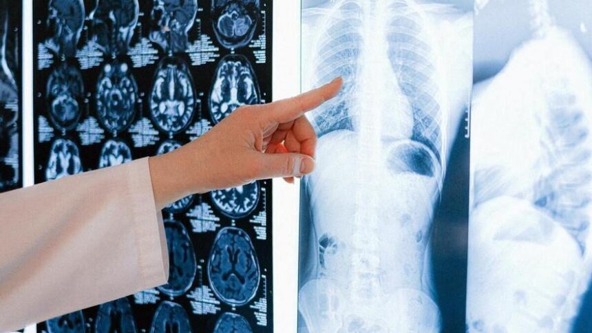 un-farmaco-reduce-la-recaida-de-un-76%-de-los-pacientes-con-un-tipo-de-cancer-de-pulmon-que-afecta-a-jovenes-y-no-fumadores
