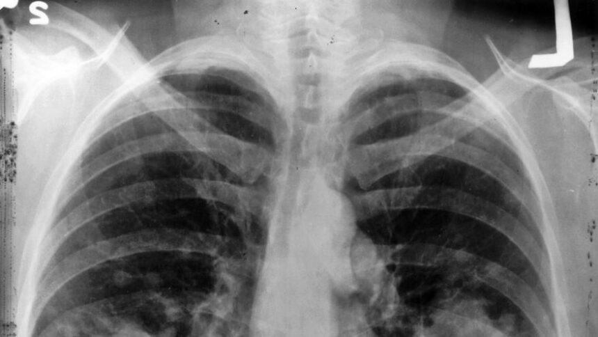 esperanza-en-cancer-de-pulmon:-espana-ya-tiene-un-farmaco-para-uno-de-los-tumores-mas-agresivos