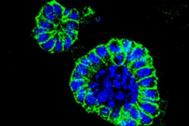 cancer-de-colon:-sanidad-trabaja-con-las-comunidades-para-mejorar-el-acceso-a-los-programas-de-cribado