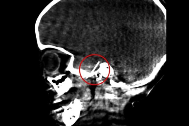 una-operacion-«inedita»:-extraen-una-aguja-de-dentista-del-cerebro-de-una-nina-de-4-anos-en-barcelona