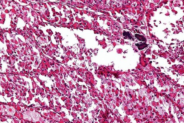 sos-de-los-pacientes-con-sarcoma:-el-40%-recibe-un-diagnostico-inicial-erroneo-o-tardio-y-empeora-su-pronostico